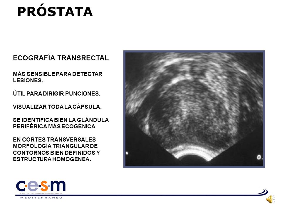 prostata de ecoestructura homogenea prostata de ecoestructura homogenea